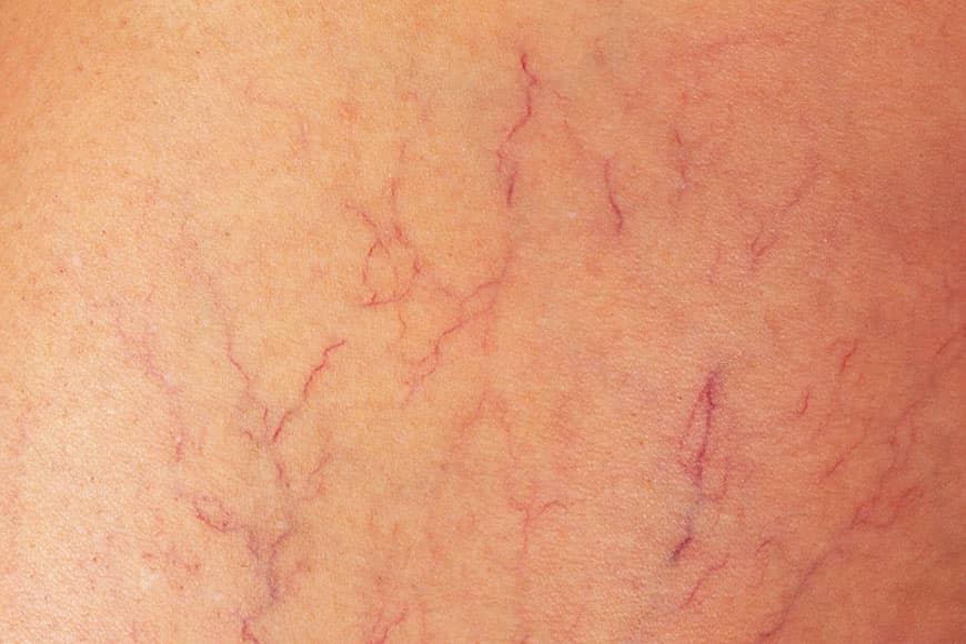 Capillary Rupture Varicose Vein Treatment