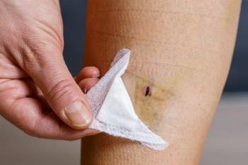 Closed Varicose Vein Surgery