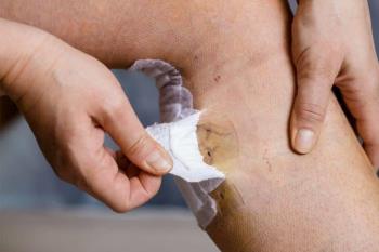 Open Varicose Vein Surgery (Classic Surgery)