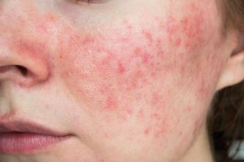 Rosacea Disease Treatment