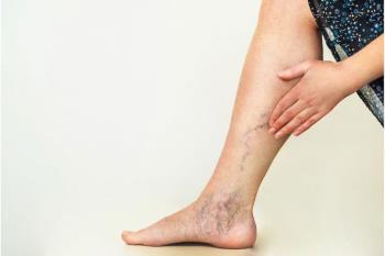 Varicose Veins Treatment