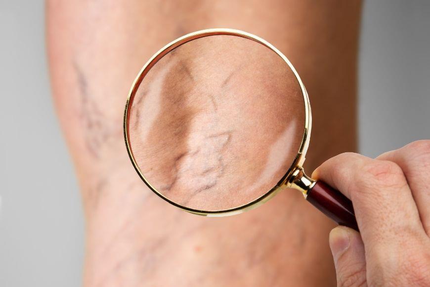 Varicose Vein Surgery in Legs