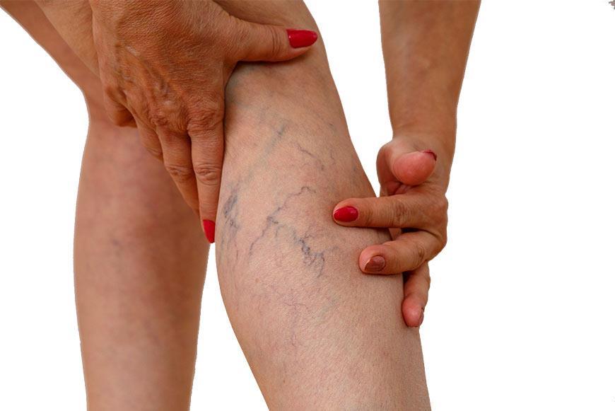 The Critical Point That Determines the Need for Varicose Vein Surgery