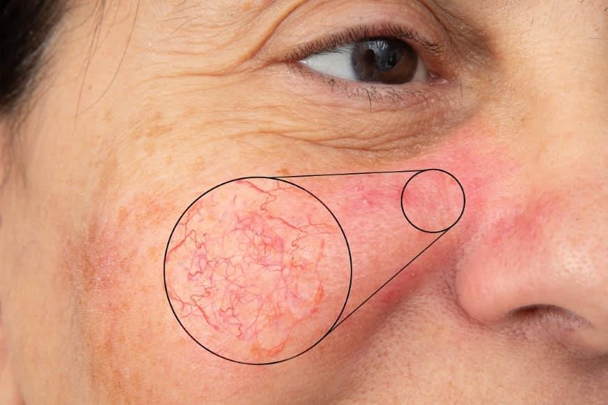 Treatment of Capillary Veins on the Face