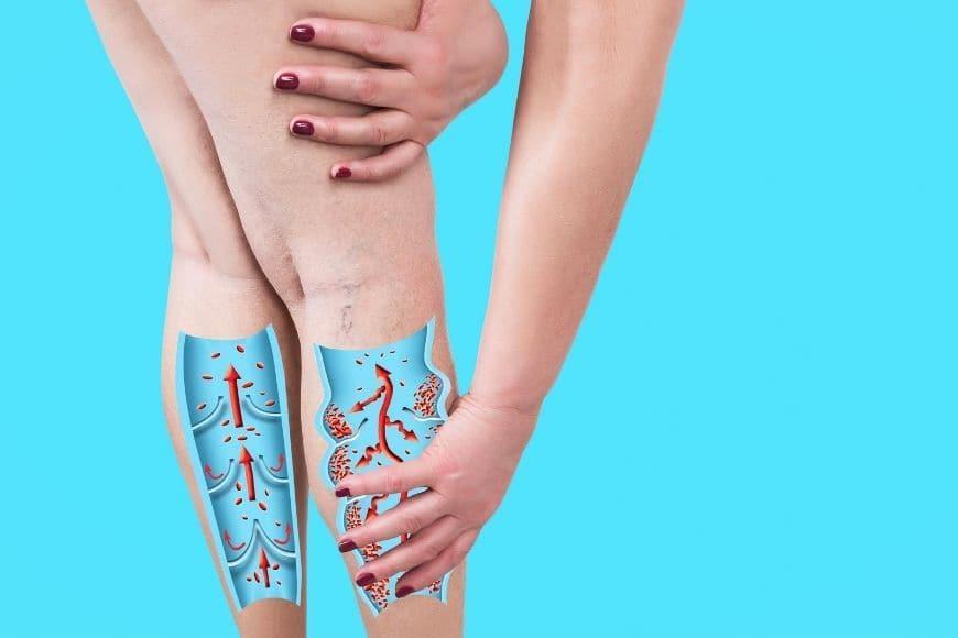 Varicose Veins Treatment in Legs