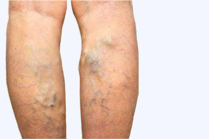 Venous Ulcer (Varicose Sore) Treatment